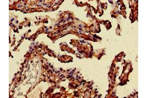 Immunohistochemistry of paraffin-embedded human lung cancer using ABIN7143899 at dilution of 1:100 (alpha-Mannosidase II antibody  (AA 31-181))
