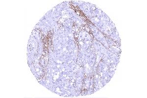 Serous high grade carcinoma of the ovary showing decorin staining of the stroma (Recombinant Decorin antibody  (AA 212-336))
