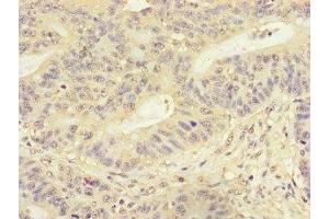Immunohistochemistry of paraffin-embedded human colon cancer using ABIN7153118 at dilution of 1:100 (Formin-Like 3 antibody  (AA 2-212))