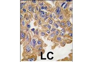 Formalin-fixed and paraffin-embedded human lung carcinoma tissue reacted with AKT2 Antibody , which was peroxidase-conjugated to the secondary antibody, followed by DAB staining. (AKT2 antibody  (AA 452-481))