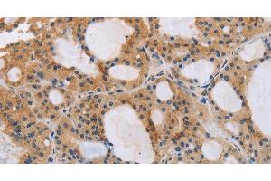 Immunohistochemistry of paraffin-embedded Human thyroid cancer tissue using ITPR1 Polyclonal Antibody at dilution 1:40 (ITPR1 antibody)