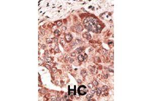 Formalin-fixed and paraffin-embedded human hepatocellular carcinoma tissue reacted with RCVRN polyclonal antibody  , which was peroxidase-conjugated to the secondary antibody, followed by DAB staining. (Recoverin antibody  (C-Term))