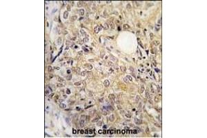 Formalin-fixed and paraffin-embedded human breast carcinoma tissue reacted with GSK3A Antibody (N-term) (ABIN6243412 and ABIN6579034) , which was peroxidase-conjugated to the secondary antibody, followed by DAB staining. (GSK3 alpha antibody  (N-Term))