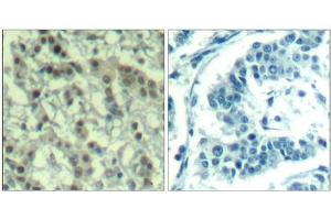 Immunohistochemical analysis of paraffin-embedded human breast carcinoma tissue using Aurora A(Phospho-Thr288) Antibody(left) or the same antibody preincubated with blocking peptide(right). (Aurora A antibody  (pThr288))