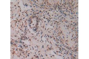 Used in DAB staining on fromalin fixed paraffin- embedded pancreas cancer tissue (PAK2 antibody  (AA 177-419))