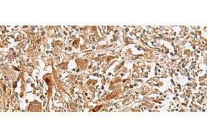 Immunohistochemistry of paraffin-embedded Human liver cancer tissue using GCC2 Polyclonal Antibody at dilution of 1:45(x200) (GCC2 antibody)