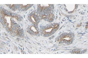 ABIN6276506 at 1/100 staining Human prostate tissue by IHC-P. (Thymidine Phosphorylase antibody  (N-Term))