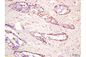 Formalin-fixed and paraffin embedded human lung carcinoma labeled with Anti-phospho-ERK5 (Ser731+Thr733) Polyclonal Antibody, Unconjugated (ABIN710276) at 1:200 followed by conjugation to the secondary antibody and DAB staining (MAPK7 antibody  (pSer731, pThr733))