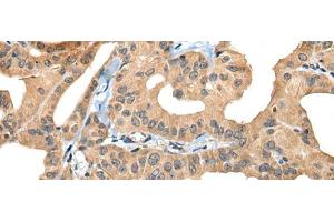 Immunohistochemistry of paraffin-embedded Human thyroid cancer tissue using BHMT2 Polyclonal Antibody at dilution of 1:30(x200) (BHMT2 antibody)