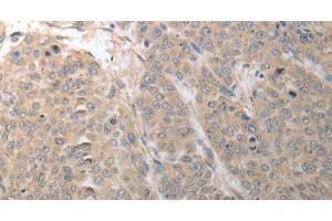Immunohistochemistry of paraffin-embedded Human liver cancer using SLC1A4 Polyclonal Antibody at dilution of 1:70 (SLC1A4 antibody)