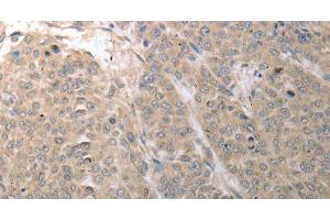 Immunohistochemistry of paraffin-embedded Human liver cancer using SLC1A4 Polyclonal Antibody at dilution of 1:70 (SLC1A4 antibody)