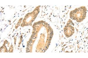 Immunohistochemistry of paraffin-embedded Human colon cancer using TSPAN13 Polyclonal Antibody at dilution of 1:35 (TSPAN13 antibody)
