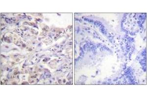 Immunohistochemistry analysis of paraffin-embedded human lung carcinoma, using hnRPD (Phospho-Ser83) Antibody. (HNRNPD/AUF1 antibody  (pSer83))