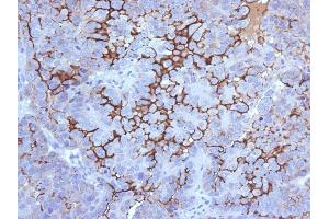 Formalin-fixed, paraffin-embedded human Ovarian Carcinoma stained with MUC16 Mouse Monoclonal Antibody (5E11). (MUC16 antibody)