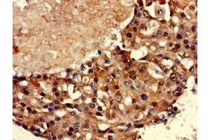 Immunohistochemistry of paraffin-embedded human breast cancer using ABIN7171581 at dilution of 1:100 (TBP antibody  (AA 1-55))
