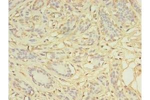 Immunohistochemistry of paraffin-embedded human breast cancer using ABIN7149384 at dilution of 1:100