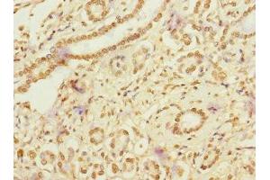Immunohistochemistry of paraffin-embedded human pancreatic cancer using ABIN7167094 at dilution of 1:100