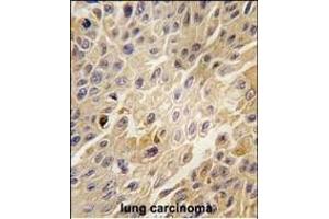 Formalin-fixed and paraffin-embedded human lung carcinoma tissue reacted with GRK2 Antibody (C-term) (ABIN1882061 and ABIN2841168) , which was peroxidase-conjugated to the secondary antibody, followed by DAB staining. (GRK2 antibody  (C-Term))