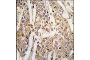 Formalin-fixed and paraffin-embedded human breast carcinoma tissue reacted with PKM2 antibody (C-term), which was peroxidase-conjugated to the secondary antibody, followed by DAB staining. (PKM2 antibody  (C-Term))
