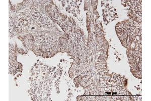 Immunoperoxidase of monoclonal antibody to ERBB3 on formalin-fixed paraffin-embedded human lung cancer. (ERBB3 antibody  (AA 21-331))