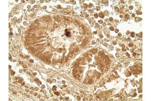 Immunohistochemistry analysis of human colon tumor tissue using Glucagon like peptide 1 pAb,  at a dilution of 1:500. (GLP-1 antibody  (AA 1-19))