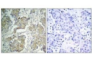 Immunohistochemical analysis of paraffin-embedded human breast carcinoma tissue using VEGFR2(Phospho-Tyr1214) Antibody(left) or the same antibody preincubated with blocking peptide(right). (VEGFR2/CD309 antibody  (pTyr1214))