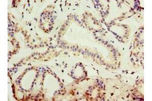 Immunohistochemistry of paraffin-embedded human breast cancer using ABIN7157726 at dilution of 1:100 (KLF3 antibody  (AA 1-240))