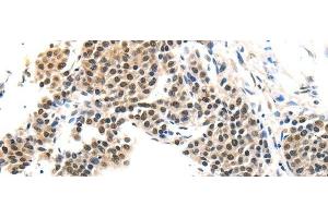 Immunohistochemistry of paraffin-embedded Human liver cancer tissue using MAGEA6 Polyclonal Antibody at dilution 1:120 (MAGEA6 antibody)