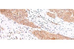 Immunohistochemistry of paraffin-embedded Human esophagus cancer tissue using COPS3 Polyclonal Antibody at dilution of 1:60(x200) (COPS3 antibody)