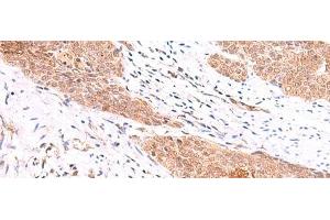 Immunohistochemistry of paraffin-embedded Human esophagus cancer tissue using COPS3 Polyclonal Antibody at dilution of 1:60(x200)