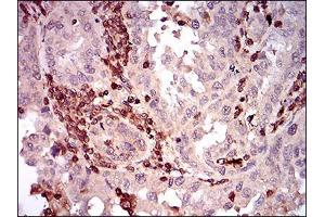 Immunohistochemical analysis of paraffin-embedded endometrial cancer tissues using CD68 mouse mAb with DAB staining. (CD68 antibody  (AA 42-155))