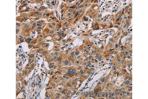 Immunohistochemistry of Human lung cancer using MMP1 Polyclonal Antibody at dilution of 1:60 (MMP1 antibody)