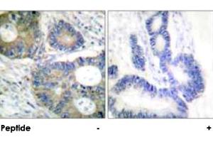 Immunohistochemical analysis of paraffin-embedded human colon carcinoma tissue using EIF4EBP1 polyclonal antibody . (eIF4EBP1 antibody)