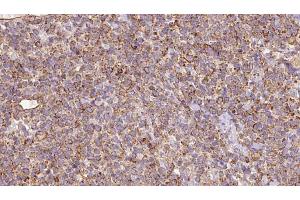 ABIN6273184 at 1/100 staining Human lymph cancer tissue by IHC-P. (SLC22A12 antibody)