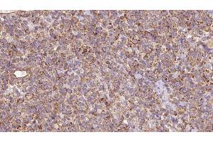 ABIN6273184 at 1/100 staining Human lymph cancer tissue by IHC-P. (SLC22A12 antibody)
