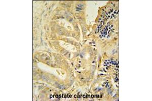 TLL1 antibody immunohistochemistry analysis in formalin fixed and paraffin embedded human prostate carcinoma followed by peroxidase conjugation of the secondary antibody and DAB staining. (TLL1 antibody  (C-Term))