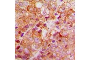 Immunohistochemical analysis of ACBD6 staining in human breast cancer formalin fixed paraffin embedded tissue section.