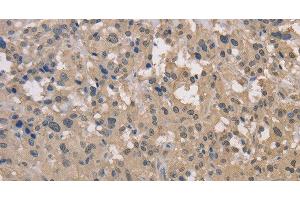 Immunohistochemistry of paraffin-embedded Human thyroid cancer using DRG1 Polyclonal Antibody at dilution of 1:30