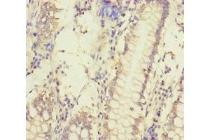 Immunohistochemistry of paraffin-embedded human colon cancer using ABIN7159632 at dilution of 1:100 (MCCC1 antibody  (AA 526-725))
