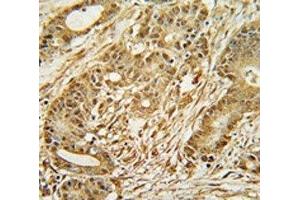 MCM2 antibody immunohistochemistry analysis in formalin fixed and paraffin embedded human colon carcinoma. (MCM2 antibody  (AA 649-677))