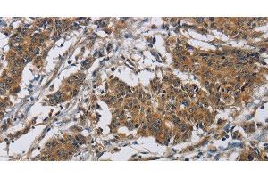 Immunohistochemistry of paraffin-embedded Human gastric cancer tissue using Claudin 8 Polyclonal Antibody at dilution 1:50 (CLDN8 antibody)