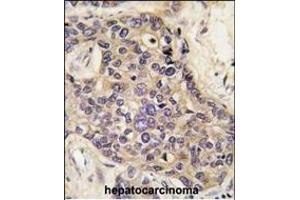 Formalin-fixed and paraffin-embedded human hepatocarcinoma tissue reacted with HGF antibody (C-term) (ABIN388462 and ABIN2848889) , which was peroxidase-conjugated to the secondary antibody, followed by DAB staining. (HGF antibody  (C-Term))