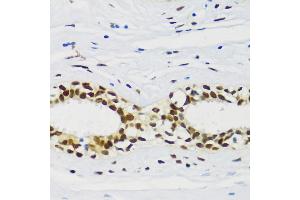 Immunohistochemistry of paraffin-embedded human breast cancer using CIRBP antibody (ABIN6129747, ABIN6138627, ABIN6138629 and ABIN6221699) at dilution of 1:100 (40x lens). (CIRBP antibody  (AA 1-172))