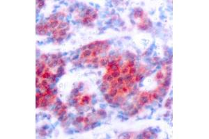 Immunohistochemistry of paraffin-embedded human breast carcinoma using Phospho-ST-Y693 antibody (ABIN3019610, ABIN3019611, ABIN3019612, ABIN1682083 and ABIN1682084). (STAT4 antibody  (pTyr693))