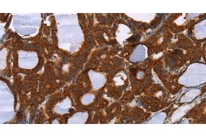 Immunohistochemistry of paraffin-embedded Human thyroid cancer tissue using PPP2R3C Polyclonal Antibody at dilution 1:30 (PPP2R3C antibody)