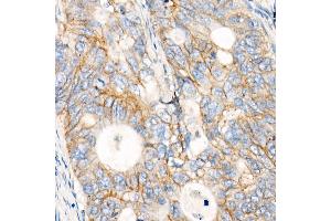 Immunohistochemistry of paraffin-embedded human colon carcinoma using MRP1/ antibody (ABIN7265736) at dilution of 1:100 (40x lens). (ABCC1 antibody)