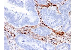 Formalin-fixed, paraffin-embedded human Colon Carcinoma stained with Nestin Mouse Monoclonal Antibody (NES/2911). (Nestin antibody  (AA 698-844))