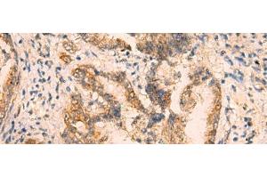 Immunohistochemistry of paraffin-embedded Human cervical cancer tissue using CRYM Polyclonal Antibody at dilution of 1:65(x200) (CRYM antibody)