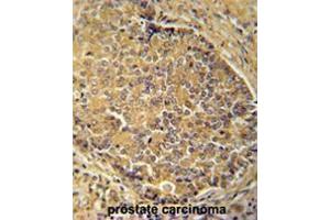 IGSF1 antibody (C-term) immunohistochemistry analysis in formalin fixed and paraffin embedded human prostate carcinoma followed by peroxidase conjugation of the secondary antibody and DAB staining. (IGSF1 antibody  (C-Term))