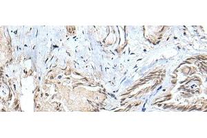 Immunohistochemistry of paraffin-embedded Human thyroid cancer tissue using SMC1A Polyclonal Antibody at dilution of 1:30(x200) (SMC1A antibody)
